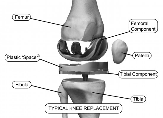 Illustration Of Typical Knee Replacement Hardware Components Re Hip And Knee Handbook Of