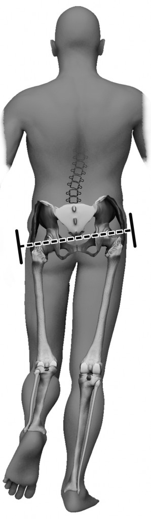 Illustration Showing A Weak Gluteus Medius And The Resulting Pel Hip And Knee Handbook Of